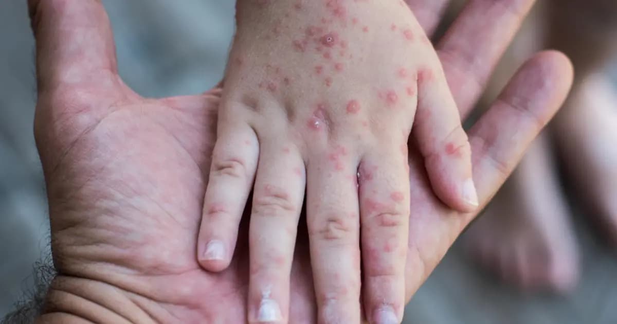 CASOS DE SARAMPIÓN SUBEN DE 74 A 86 EN UNA SEMANA EN EL PAÍS