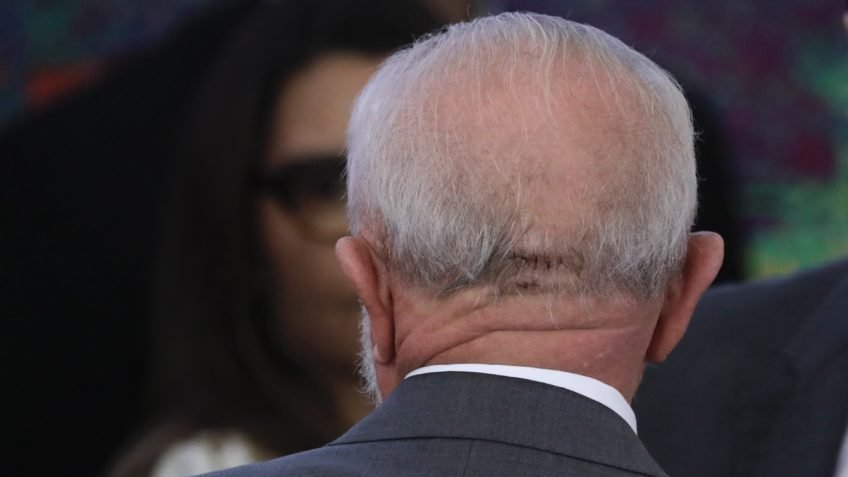 LULA DA SILVA FUE OPERADO DE EMERGENCIA POR UNA HEMORRAGIA INTRACRANEAL