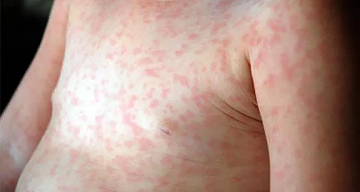 SALUD REPORTA 50 CASOS DE SARAMPIÓN; LA PAZ Y POTOSÍ REGISTRAN SUS PRIMEROS CONTAGIOS