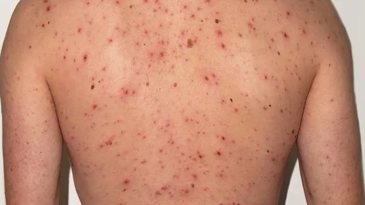 SUBEN A 23 LOS PACIENTES CON SARAMPIÓN EN SANTA CRUZ