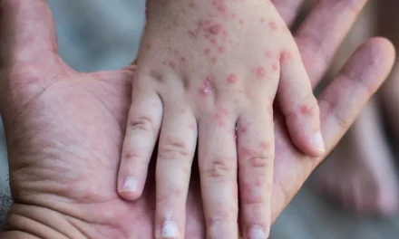 CASOS DE SARAMPIÓN SUBEN DE 74 A 86 EN UNA SEMANA EN EL PAÍS