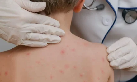 COCHABAMBA REPORTA EL TERCER CASO DE SARAMPIÓN