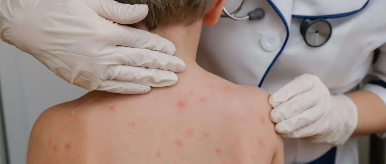 COCHABAMBA REPORTA EL TERCER CASO DE SARAMPIÓN