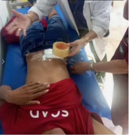 EN RIBERALTA HACEN CURACIONES CON DIUREX PORQUE NO HAY TELA ADHESIVA