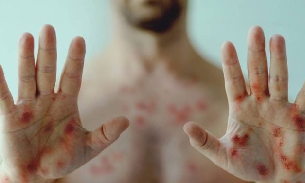 SEDES CONFIRMA DOS CASOS DE VIRUELA DEL MONO Y CUATRO SOSPECHOSOS EN SANTA CRUZ