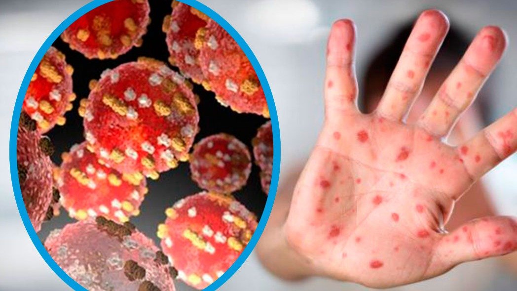 SALUD EN ALERTA: SANTA CRUZ CONFIRMA NUEVO CASO DE VIRUELA DEL MONO TRAS PROLONGADO PERIODO SIN CONTAGIOS